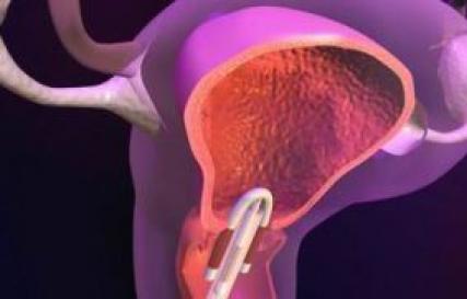 Internal uterine devices (IUD): principles of vicorization